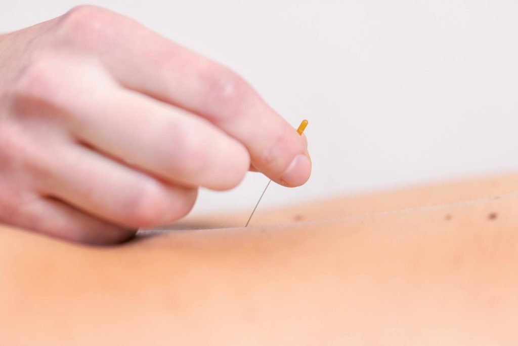 Behandeling dry needling