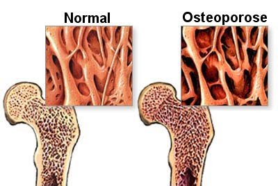 Osteoporose Behandeling: de rol van fysiotherapie achtse barrier