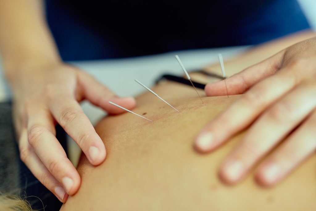 Dry needling: de effectieve oplossing voor spierklachten en triggerpoints